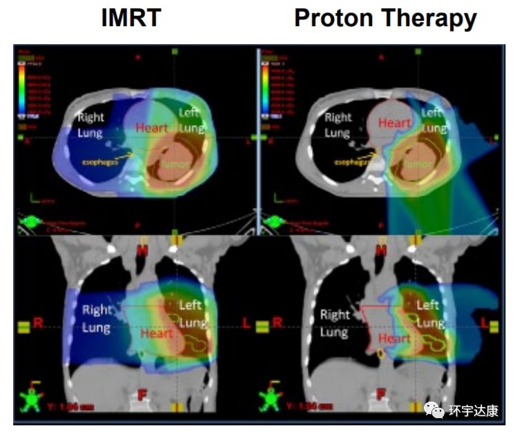 如何降低肺癌患者心脏病风险？质子治疗更胜于普通放疗！