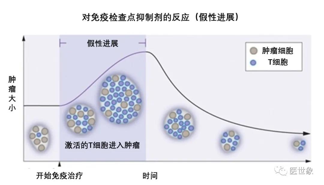 肺癌免疫治疗过程中的“假性进展”