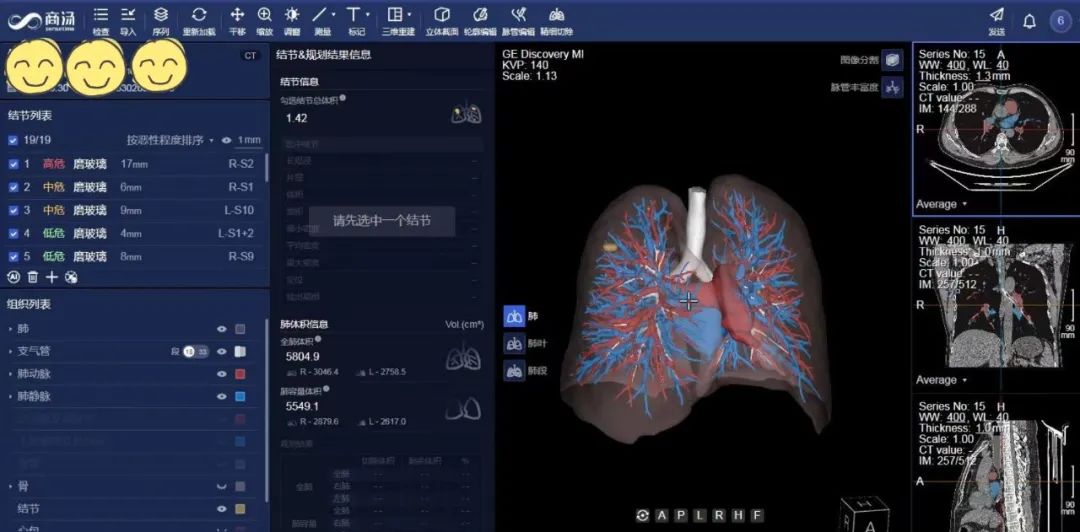 Lung Cancer care